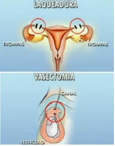 laqueadura-vasectomia