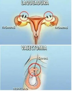 laqueadura-vasectomia