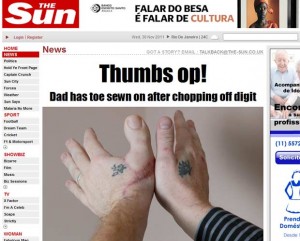 britanico-tem-dedao-do-pe-implantado-no-lugar-do-polegar