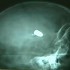 Criança passa uma semana com bala na cabeça sem diagnóstico